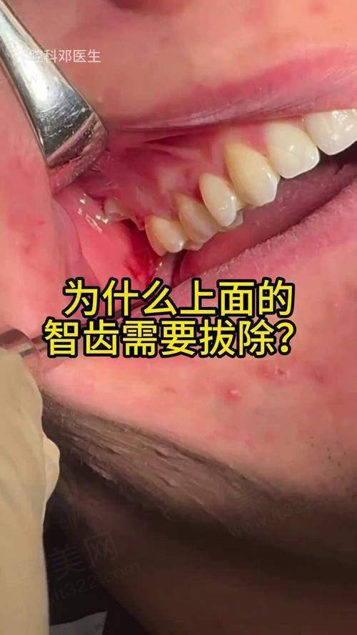 医院拔智齿当天能拔吗？综合考虑选对医院