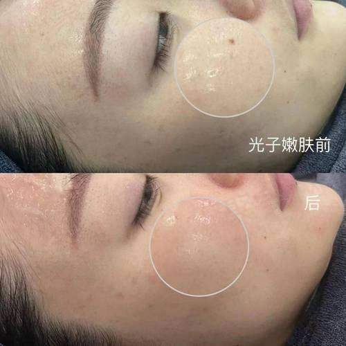 成都友谊整形M22光子嫩肤全模式的服务体验怎么样？