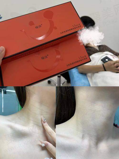 成都友谊整形嗨体1.5mL去颈纹有哪些优势呢？