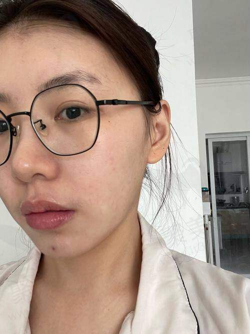 成都素美医疗美容红蓝光治痘原价2000元，现99元起享健康疗法焕肤体验！