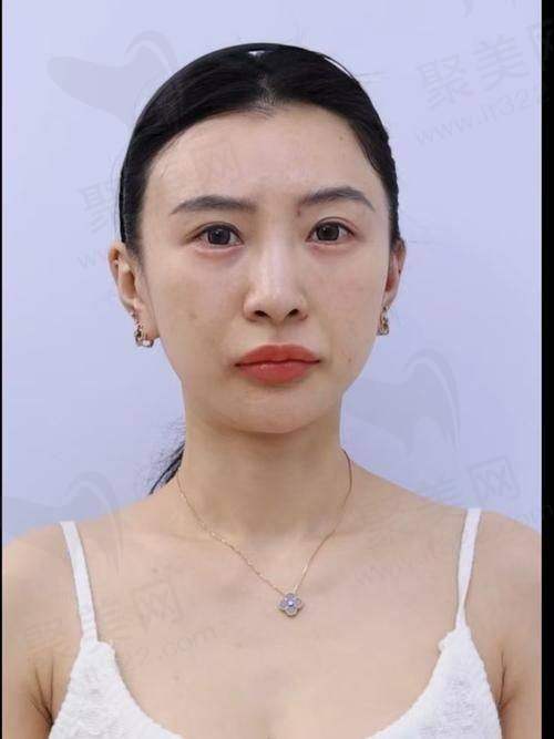 北京嘉禾医疗美容医院陈媛乔雅登雅致玻尿酸项目价格解析