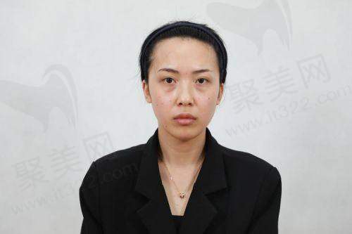 弗缦胶原填泪沟的成效及持久性