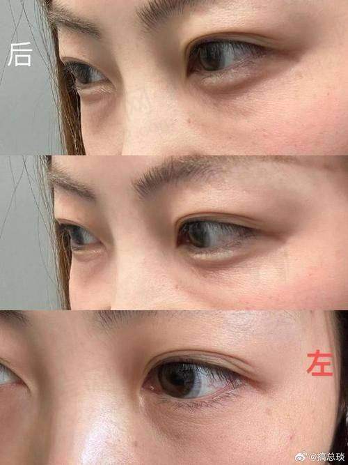 四、选择合适的去泪沟方案