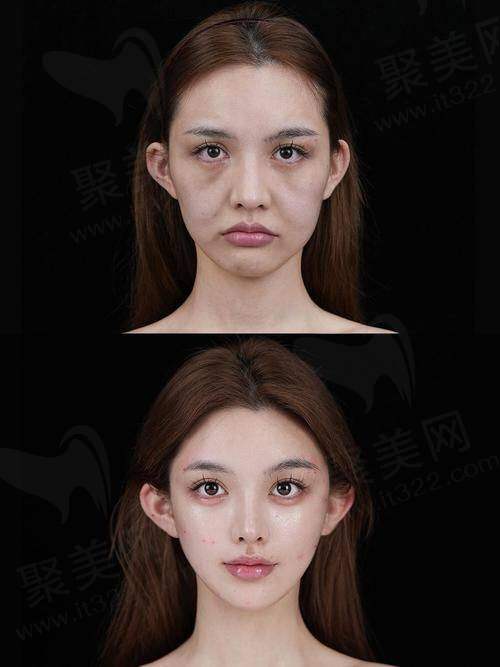 深圳陈群筋膜提升的手术成效