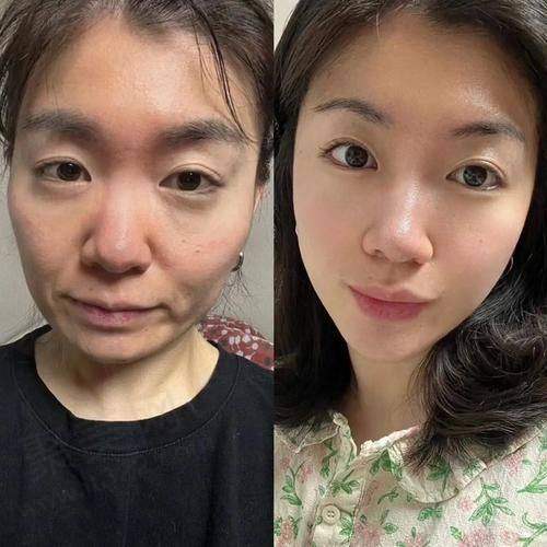 深圳陈群筋膜提升的综合评价