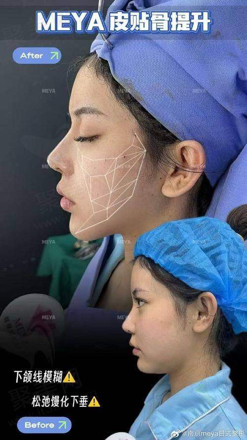 深圳陈群筋膜提升怎么样？近20年经验，手术效果优，医院口碑好值得选