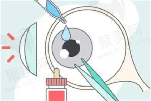 北京至亮眼科离焦镜的原理