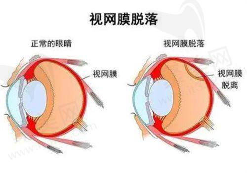 北京至亮眼科离焦镜的显著成效