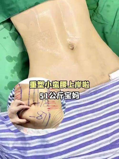 大连沙医生整形腰腹环吸15000元起，改良水动力负压吸脂，术后无褶皱凹凸！