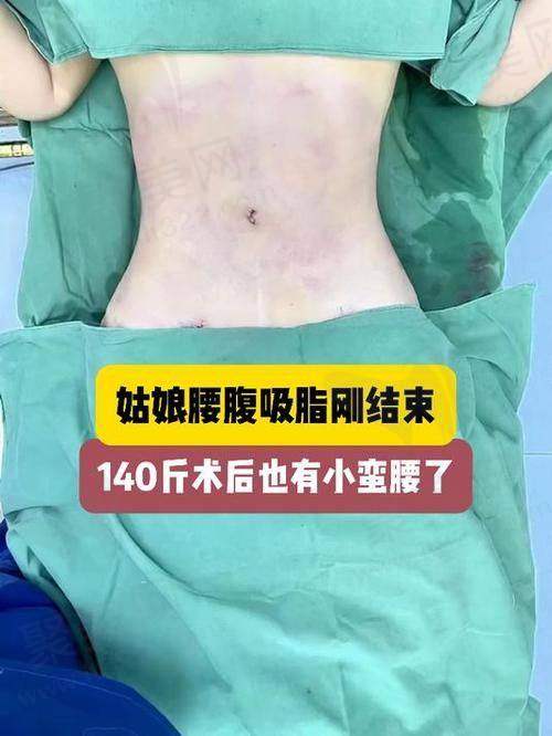 大连沙医生整形腰腹环吸成功实例分享