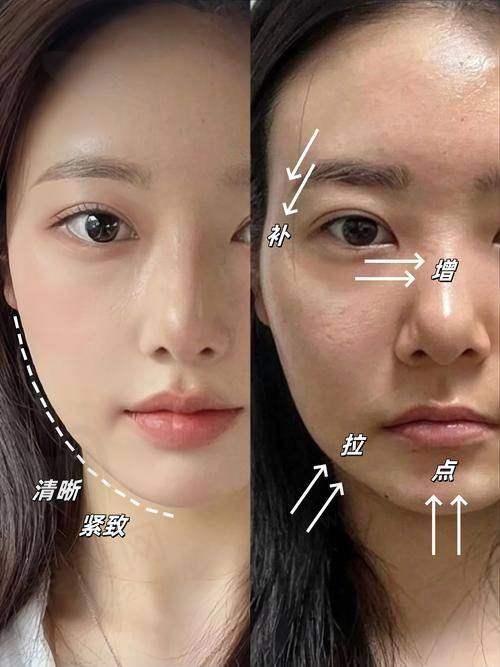 三、邓业平法令纹平移术