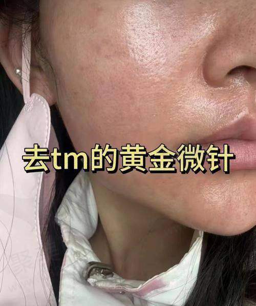 大连沙医生整形西弥斯黄金微针是什么？