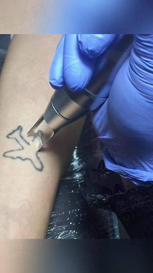 成都素美医疗美容皮秒激光去纹身的作用和成效