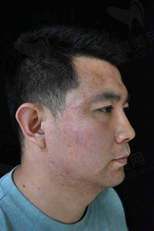 大连沙医生整形西弥斯黄金微针的技术优势有哪些？