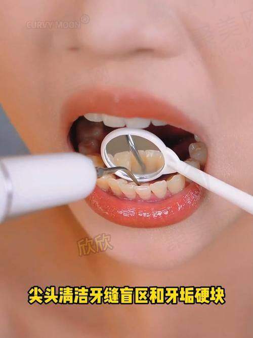 成都医大口腔医院瑞士进口深度洁牙189元起，全方位清洁护龈还您亮白健康美牙