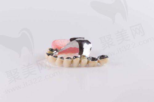 三、镶牙的额外费用