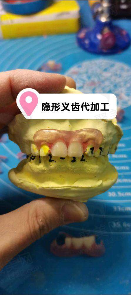 南通美奥口腔医院普通树脂活动义齿有哪些成效呢？