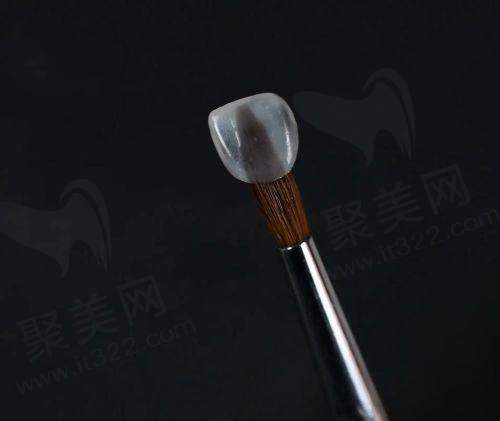 南通美奥口腔E-max品牌超薄贴面有哪些特性和优势？