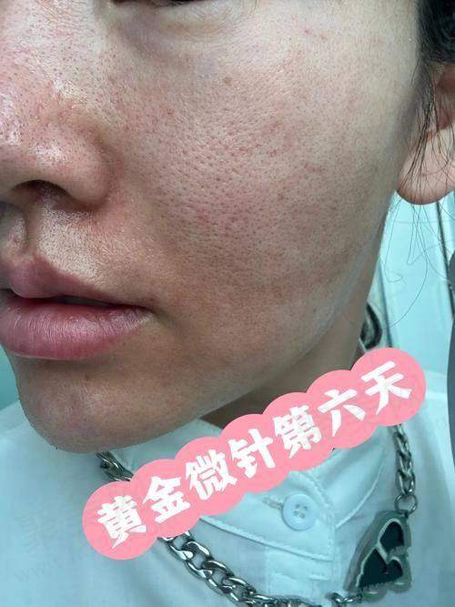 大连沙医生半岛黄金微针4.0全方面部项目技术水平