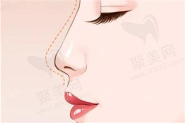 湛江韩美整形医院做鼻子怎么样？杨开波和钟贵红医生鼻整形效果口碑出彩