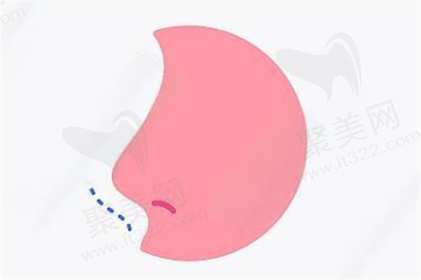 北京米扬丽格巫文云鼻整形属于什么级别？医生、技术、收费全是国内较高水平！