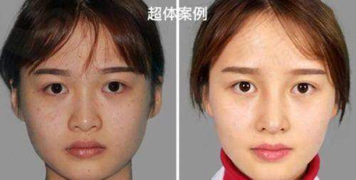 文丰做鼻子性价比如何，有哪些注意事项？