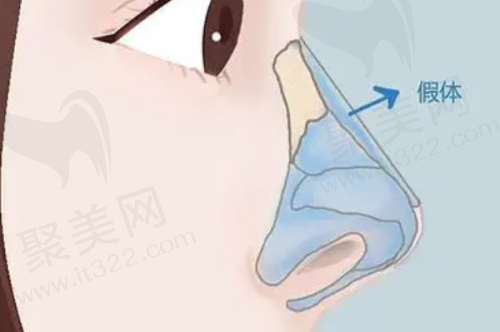 上海叶丽萍医生做鼻子怎么样？正规出身技术精湛，多实例见证卓越隆鼻成效！ 