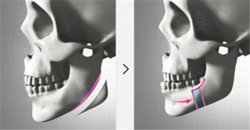 真实实例:见证异物取出的显著成效