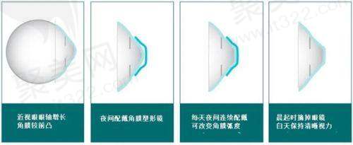 上海新视界眼科医院患者验光配镜体验