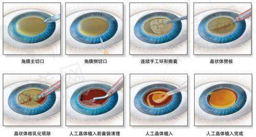 南宁爱尔眼科曾思明院长白内障超声乳化价格6千起，小切口快恢复舒适就医体验佳