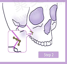 刘志刚眼修复价格详情
