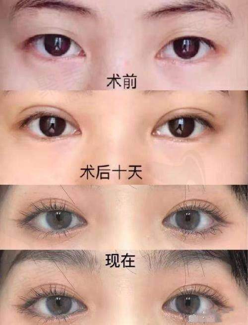 杭州美莱孟晨曦的眼部修复技术怎么样？