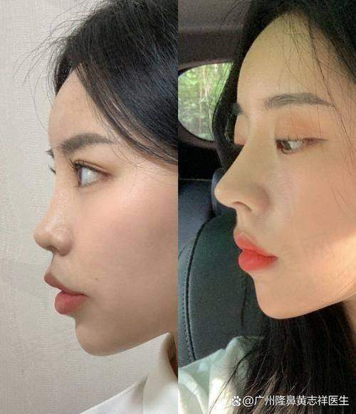 湛江韩美整形医院做鼻子，术后成效和口碑好吗？
