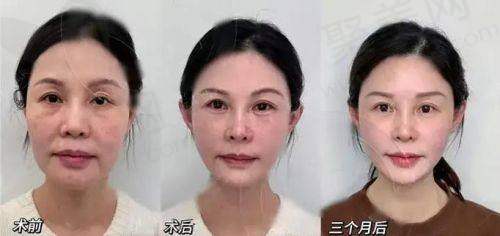童颜针对皱纹的改善成效