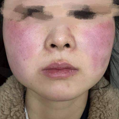 川字纹永久消除价格解析：注射玻尿酸与胶原蛋白及其他方法的费用对比与效果分析
