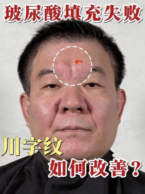 川字纹恒久消除价格与注射玻尿酸的关系