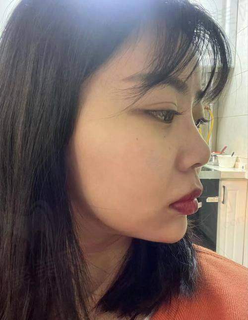 大连沙医生整形伊婉C玻尿酸的技术优势