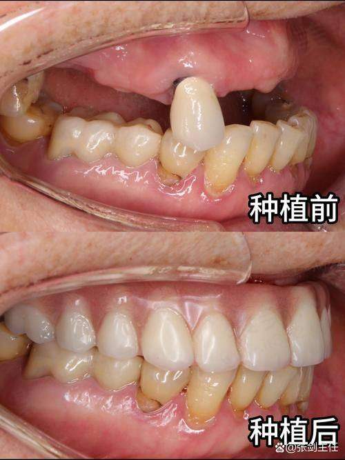 温州艺星口腔医院种植牙医生的成功实例多吗？