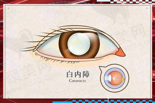 南宁爱尔眼科曾思明院长白内障超声乳化手术技术有哪些优势？