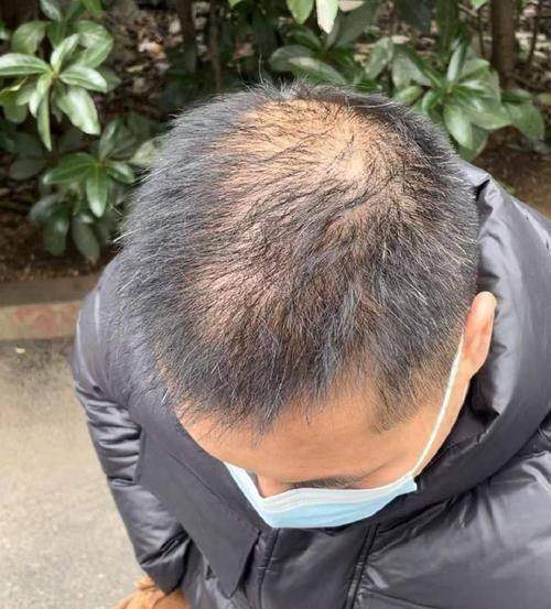 二、植发技术原理与可靠性