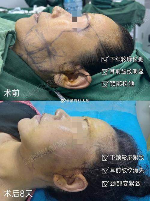 做个小拉皮手术多少钱？上海的费用情况