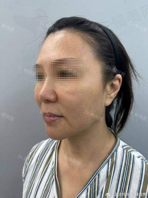 做个小拉皮手术多少钱？拉皮手术费用一览：不同年龄适合的拉皮类型与效果解析，海芙音波小拉皮价格及维持时间详解
