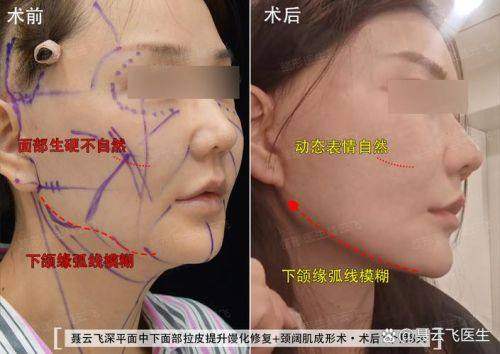海芙音波小拉皮的费用及成效