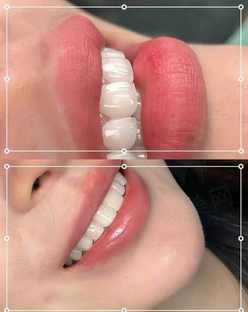 成都医大口腔E-MAX瓷贴面的医院服务优势