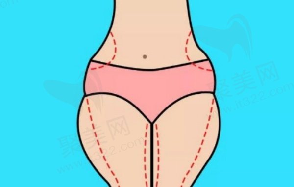 重庆军科王棚用零式吸脂瘦大腿5880元起，微创无痛，术后腿长臀翘效果超棒