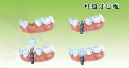 七、聂鑫医生怎么预约？