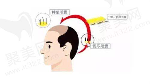 影响上海九院植发费用的因素