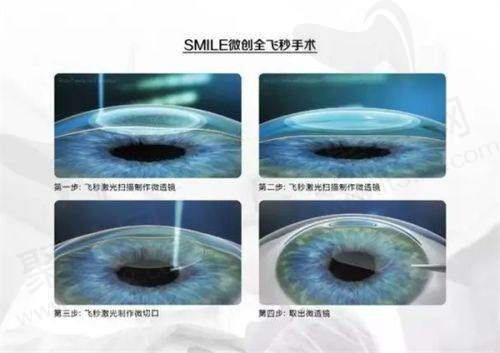 保定新视眼科医院申文辉做白内障三焦晶体植入术23800元起，解决远中近视力难题！