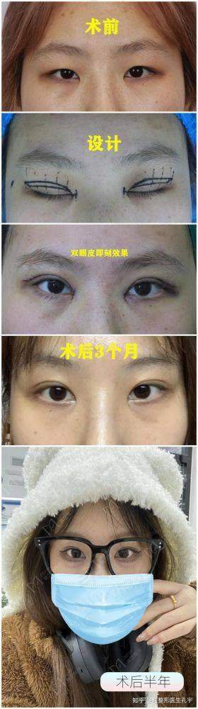 谭敏峰双眼皮属于什么档次？独特技术彰显高端品质