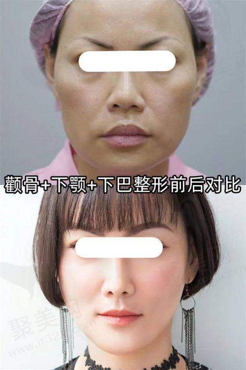 五、如何选择适合自己的上睑除皱方案